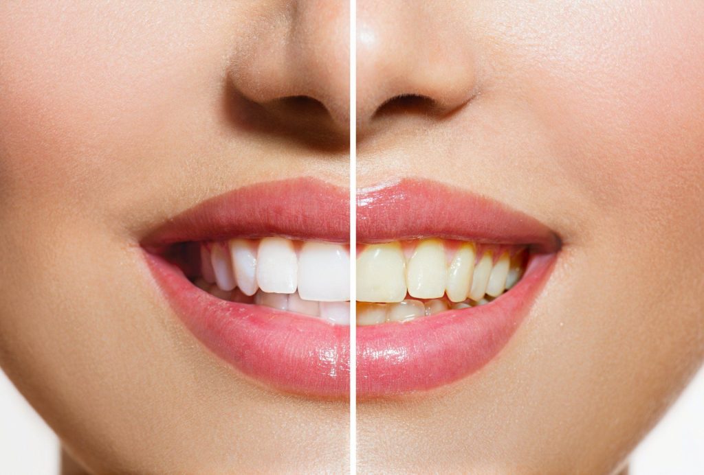 before and after teeth whitening