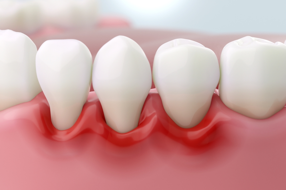 gum disease and inflammation