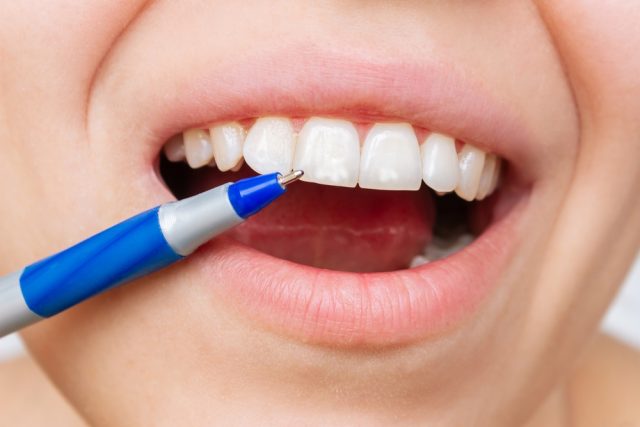 calcium stains on teeth