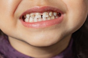 enamel hypoplasia