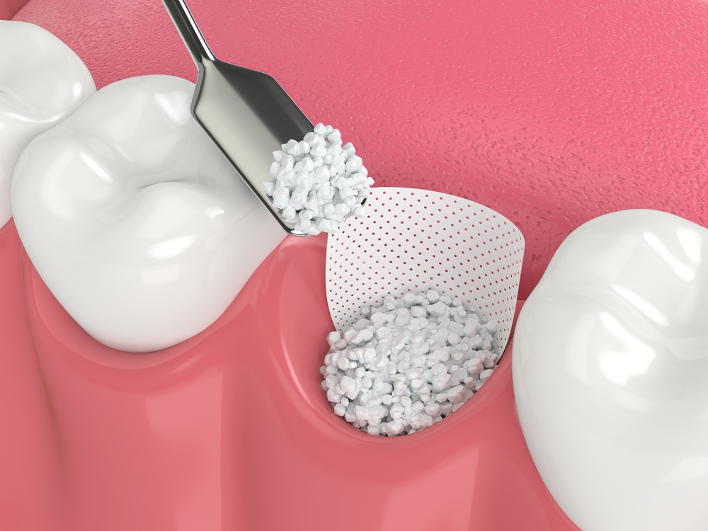 bone grafting