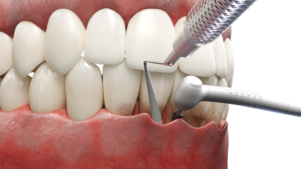pocket reduction therapy