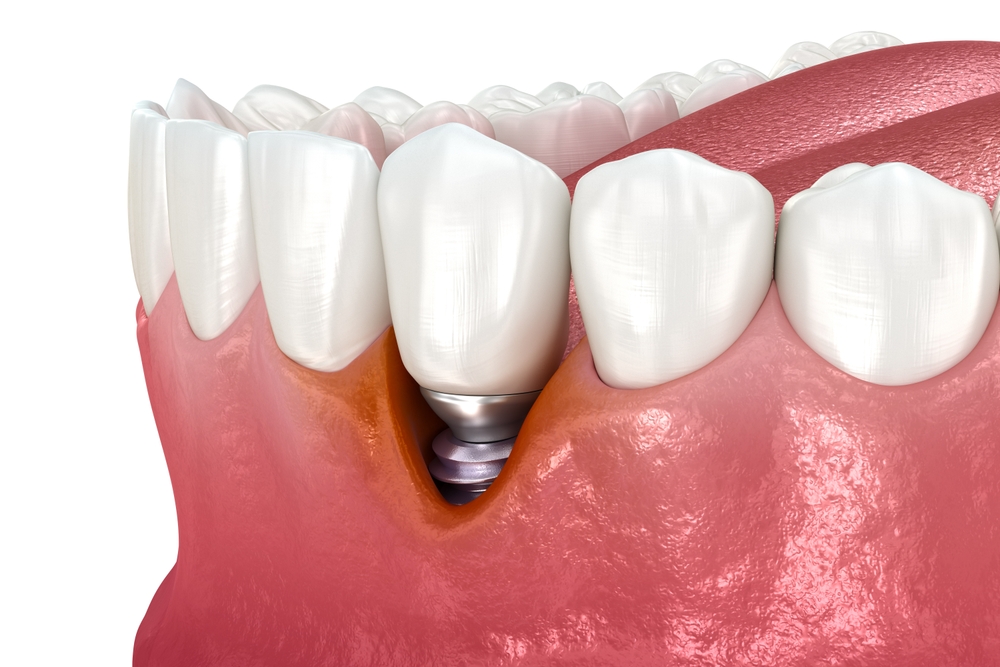 gum recession around implant