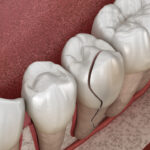 cracked tooth