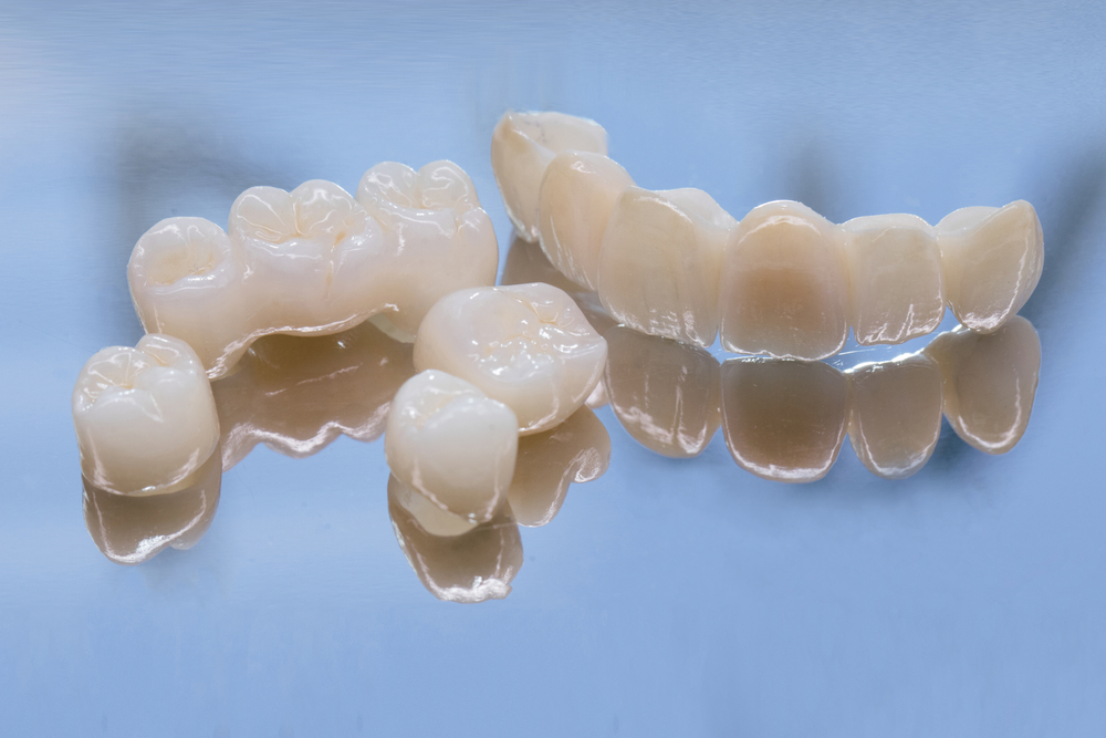 dental crowns, dental bridges, and veneers